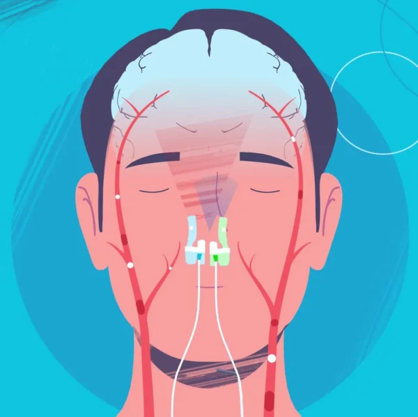An illustration of a man's head with a Vielight MIP Intranasal Photobiomodulation device.